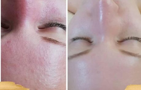 Kozmetikai kezelés előtt és után