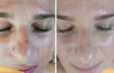 Kozmetikai kezelés előtt és után